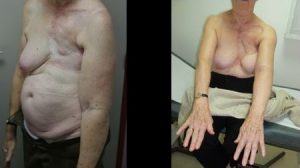 Outcome of an enlarged DIEP on a patient who suffered lymphoedema for 20 years after a mastectomy