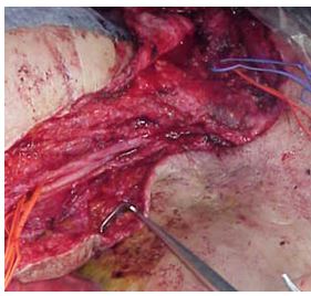 ALNT surgical technique: complete dissection of the nerves and axillar vein , and thoracodorsal vessels