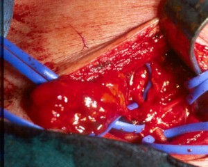 Cervical flap