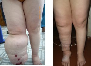 Resultados 6 mese después un LNT de una mujer que sufría elefantiasis con infecciones crónicas durante 20 años