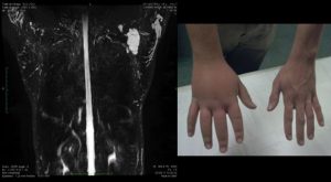 Linfedema hipertrófico congénito
