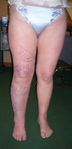 Selective external liposculpture of the leg