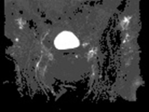 Lymphatic MRI after hysterectomy and adenomectomy, showing the absence of drainage in iliac and deep inguinal