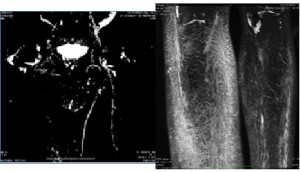 MRI linfático proporciona una mejor visualización de la anatomía del sistema linfático.