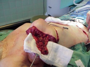 Modificación DIEP y transplante con ganglios linfáticos