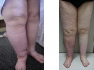 LNT works even in old leg lymphedema with chronic infections