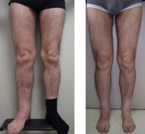11 years of lymphoedema and results 12 months after LNT