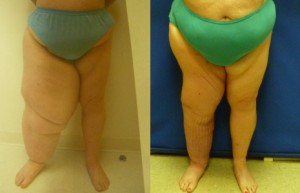 Lymphedema post treatment for melanoma and result 8 months after ALNT surgery